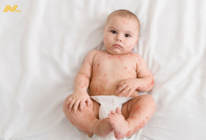 Những dấu hiệu nào cho thấy bé bị dị ứng sữa?