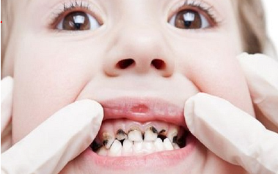 Các vấn đề răng miệng thường gặp ở trẻ em