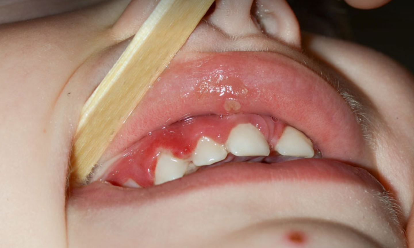 Hình ảnh trẻ bị viêm nướu