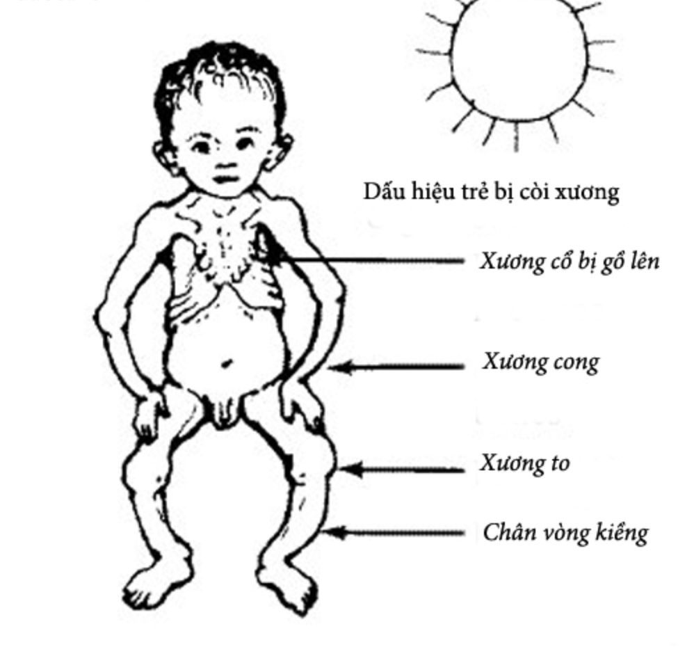 Dấu hiệu trẻ bị còi xương