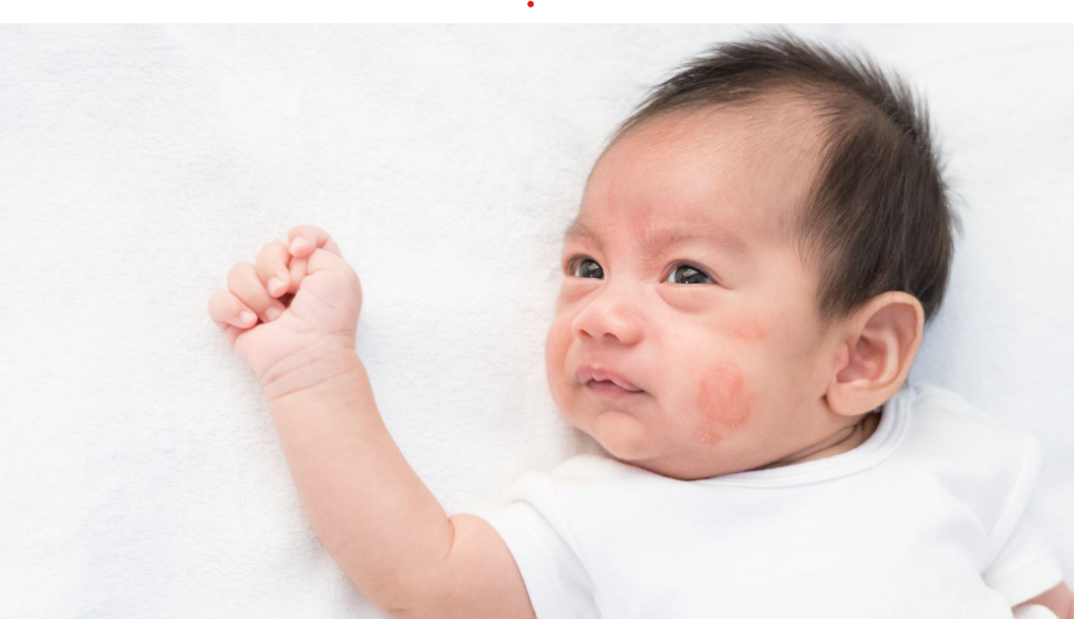 Trẻ dị ứng đạm bò