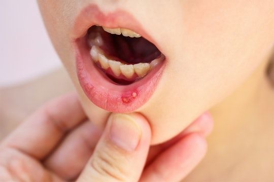 Vết nhiệt miệng 
